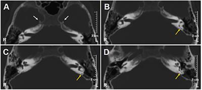 Posterior semicircular canal ossification following acute vestibular loss mimicking inferior vestibular neuritis: A case report